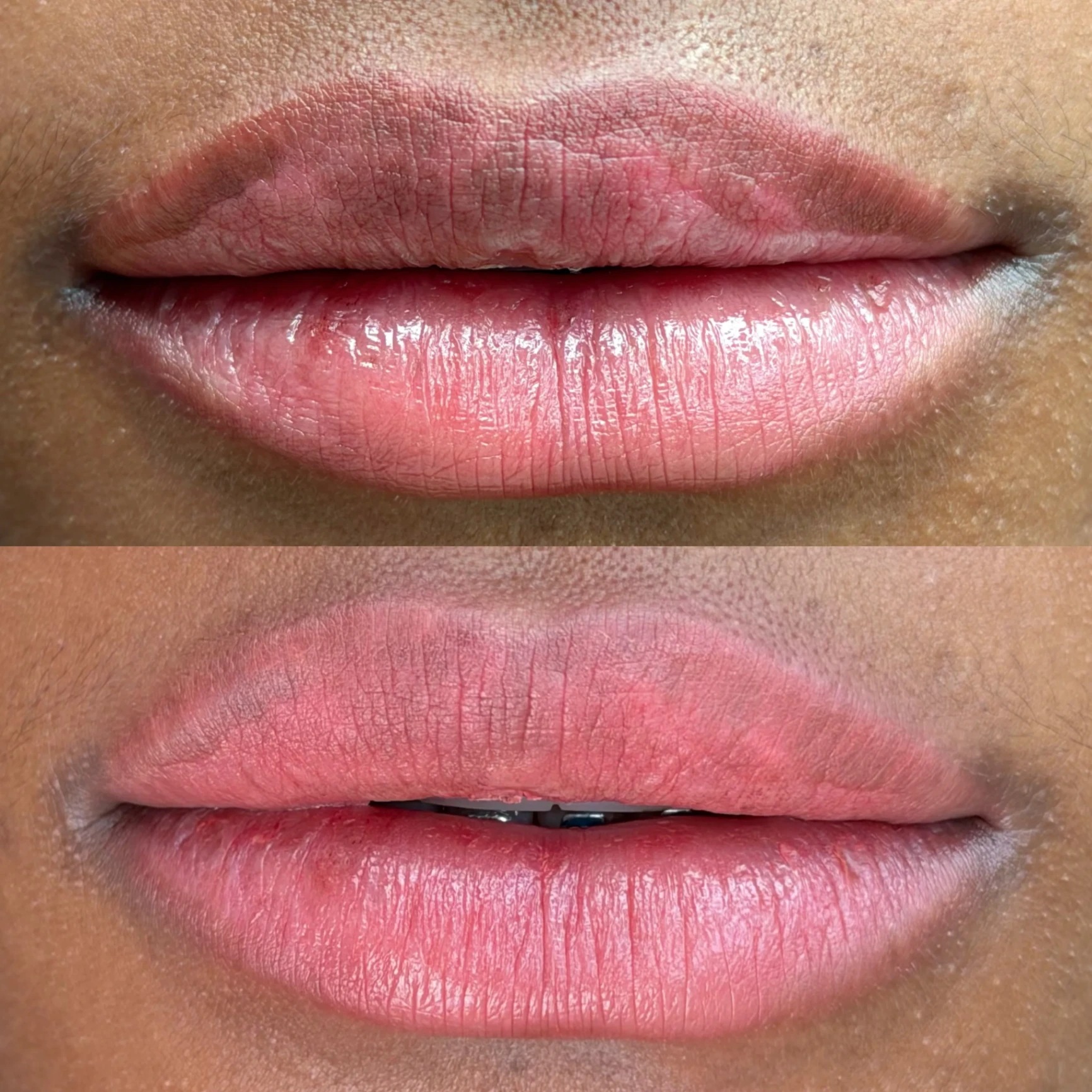 Micropigmentación de labios caso correctivo en Medellín — Carolina Zarate Clinic 1